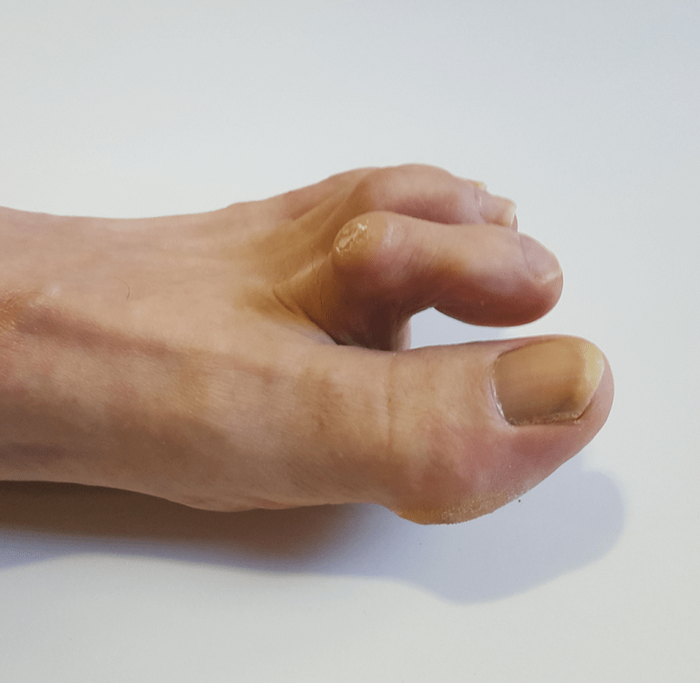 Tooth Toe NERVES & NEUROPATHIES DEMYSTIFIED – Keltican | Medicine for Neuropathies